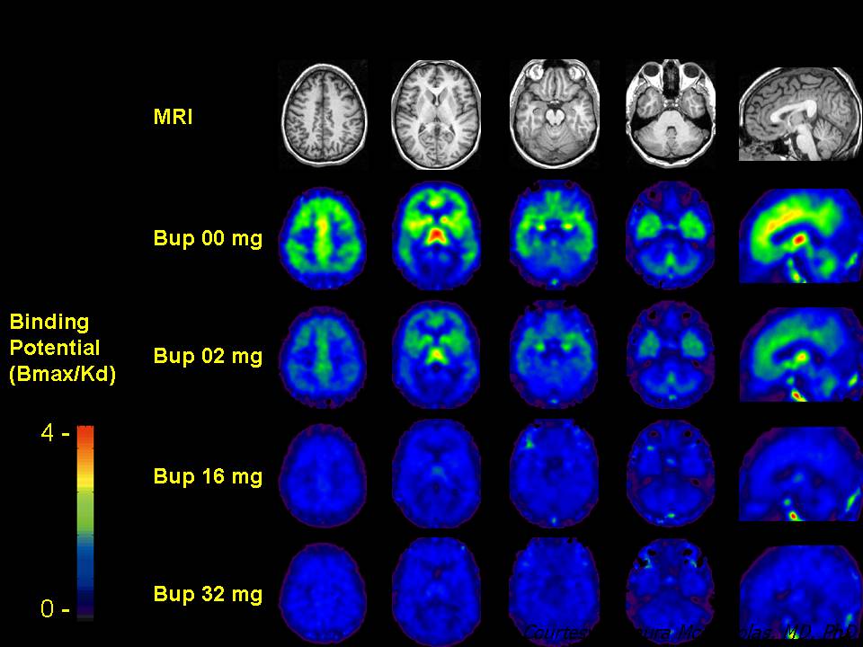 Pet Scan